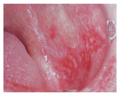 oral lichen planus cheek