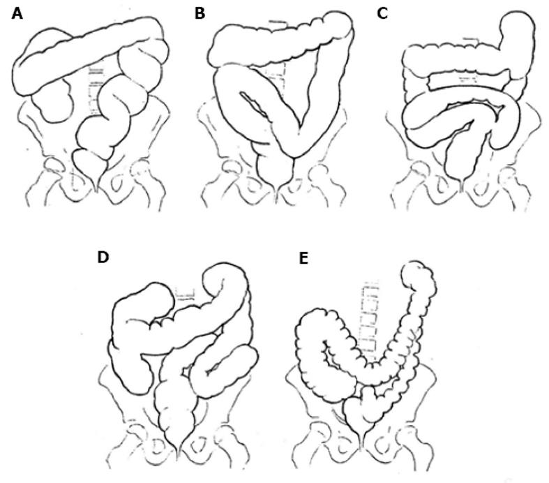 Dolichocolon Revisited An Inborn Anatomic Variant With Redundancies Causing Constipation And Volvulus