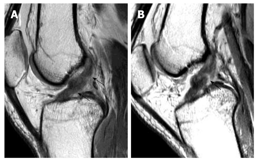Imaging of the anterior cruciate ligament