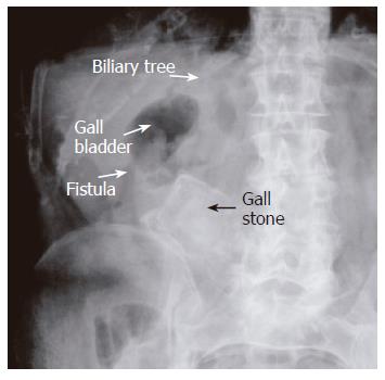 Gallstone X Ray Hi-res Stock Photography And Images Alamy, 58% OFF