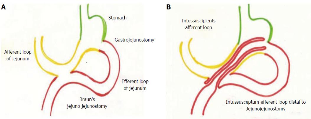 Loop Gastrojejunostomy