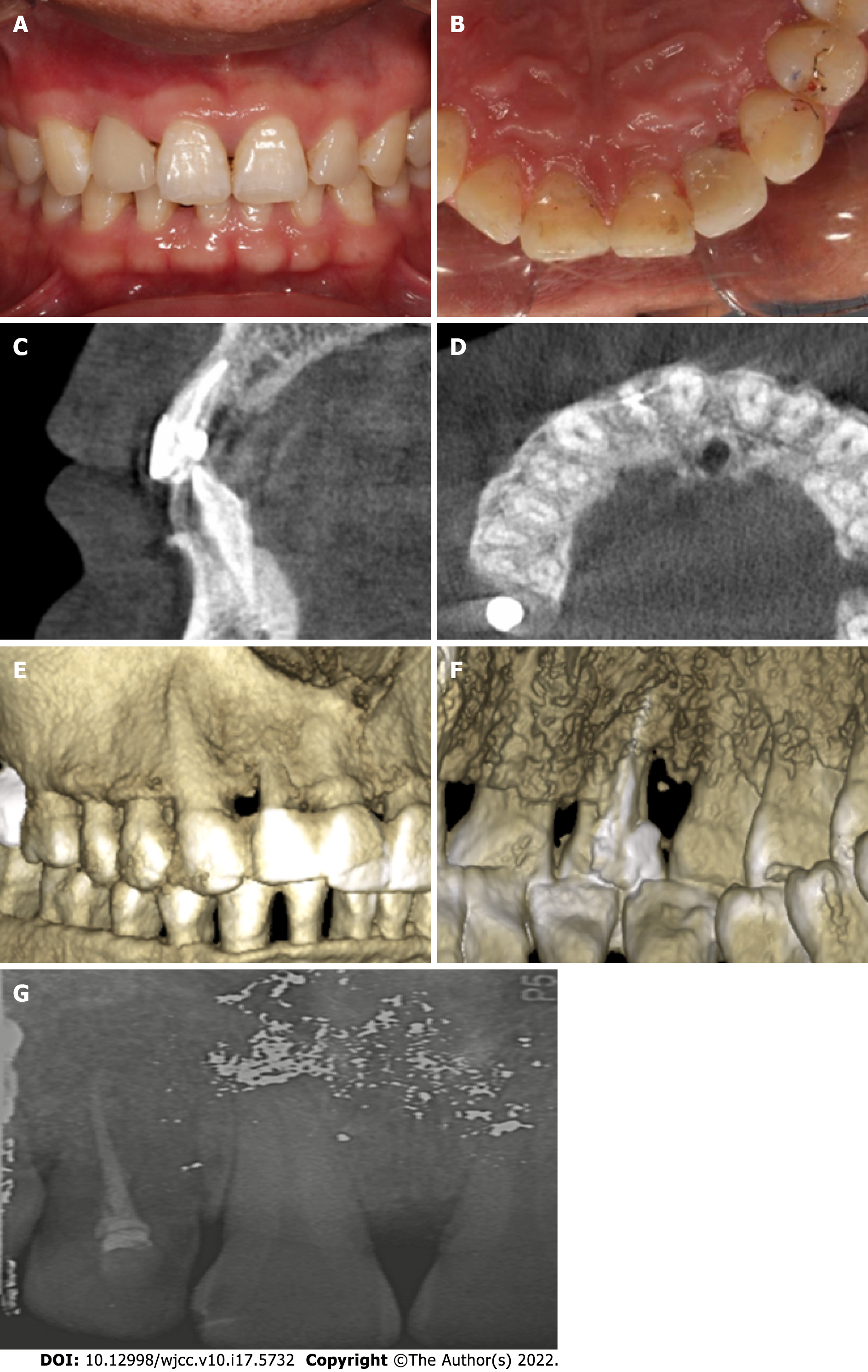 8 mm periodontal pocket depth on palatal side of 21