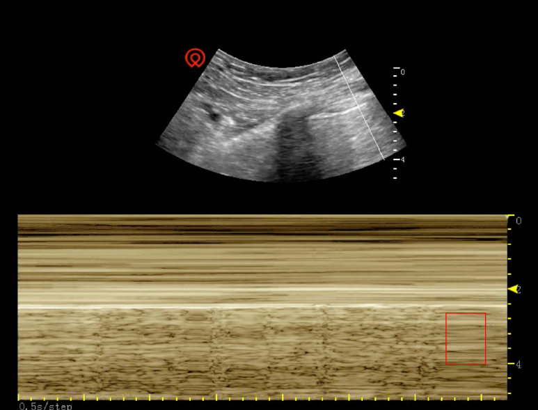 picture of pneumothorax m mode ultrasound