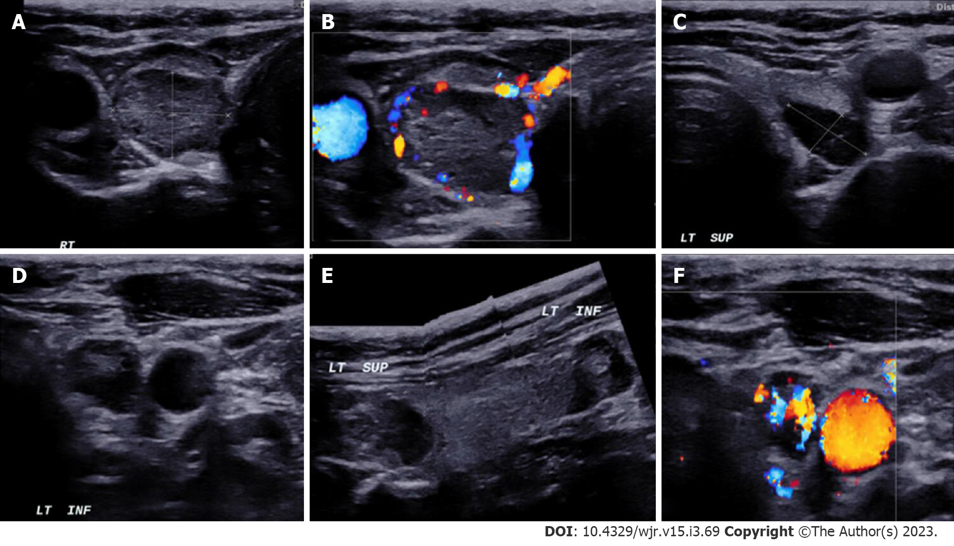 parathyroid gland ultrasound
