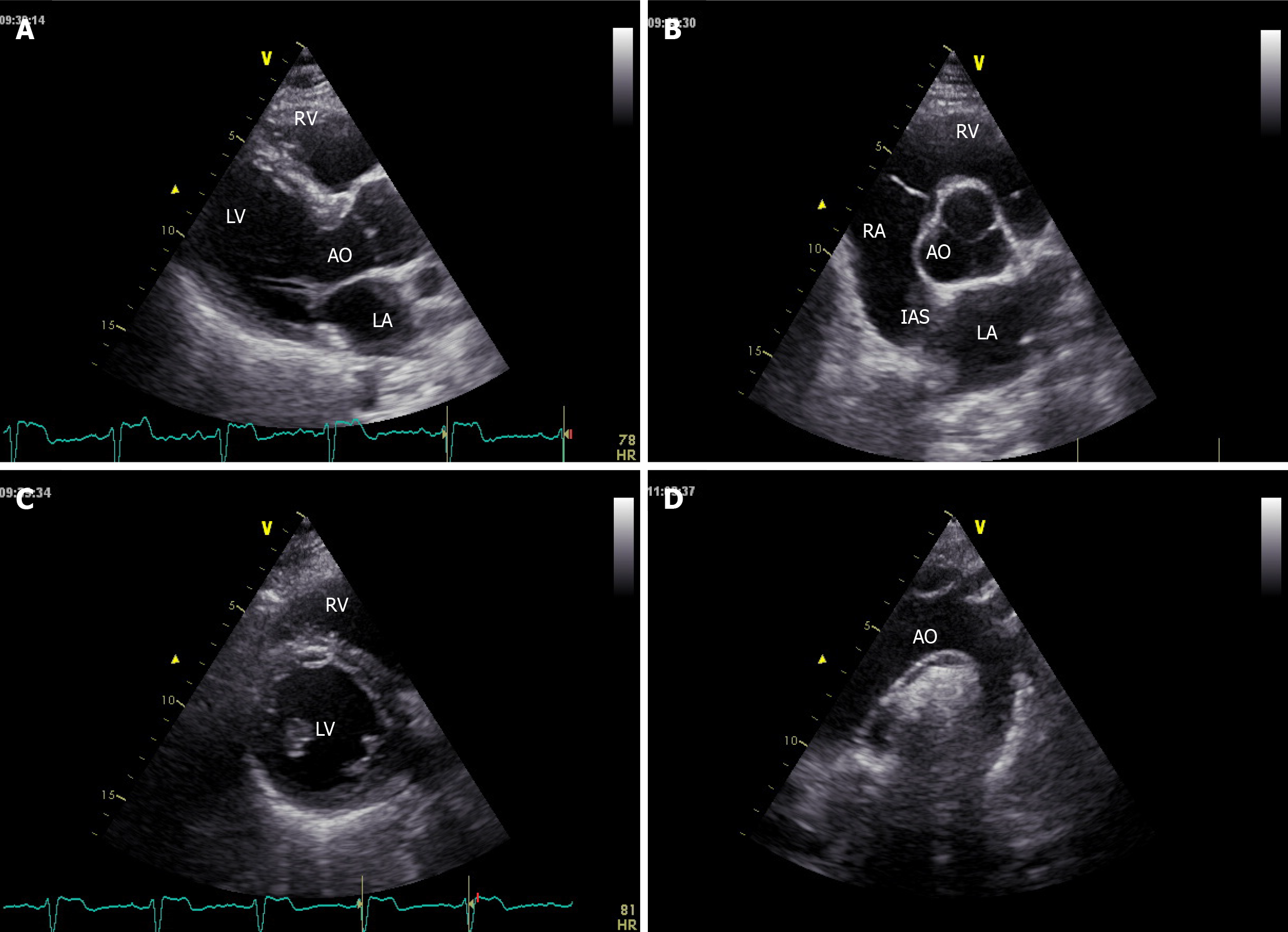 Efficacy of echocardiography for differential diagnosis of left ventricular  hypertrophy: special focus on speckle-tracking longitudinal strain