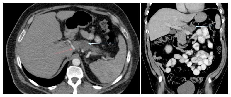 Challenges in diagnosis of pancreatic cancer