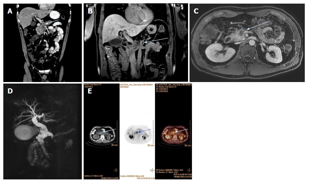 Challenges In Diagnosis Of Pancreatic Cancer