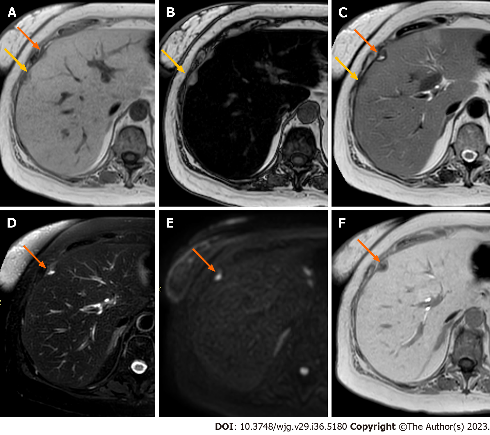 Liver metastases: The role of magnetic resonance imaging