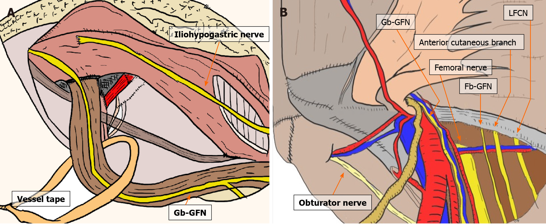 Open femoral hernia repair reveals a hernia sac containing a necrotic