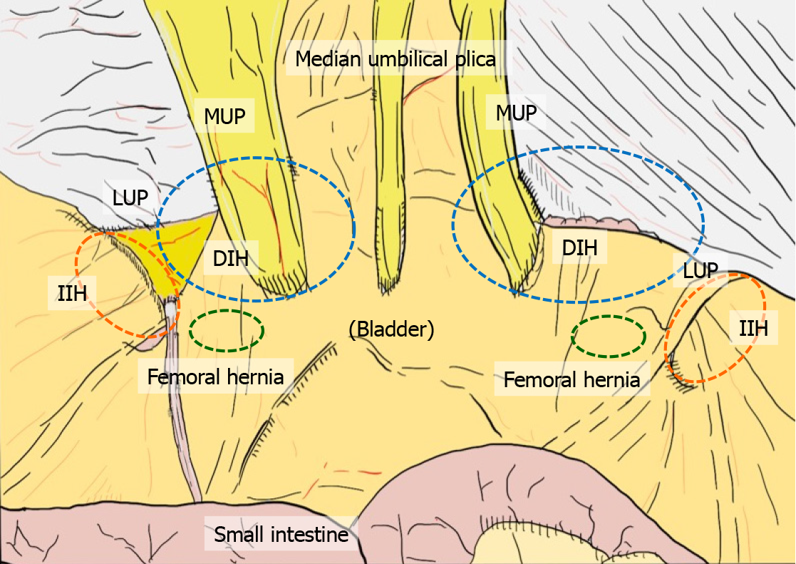 Laparoscopic repair of femoral hernia - Yang - Annals of
