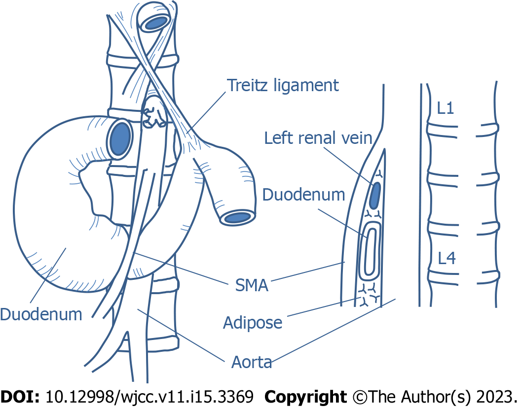 Superior Mesenteric Artery Syndrome Diagnosis And Management