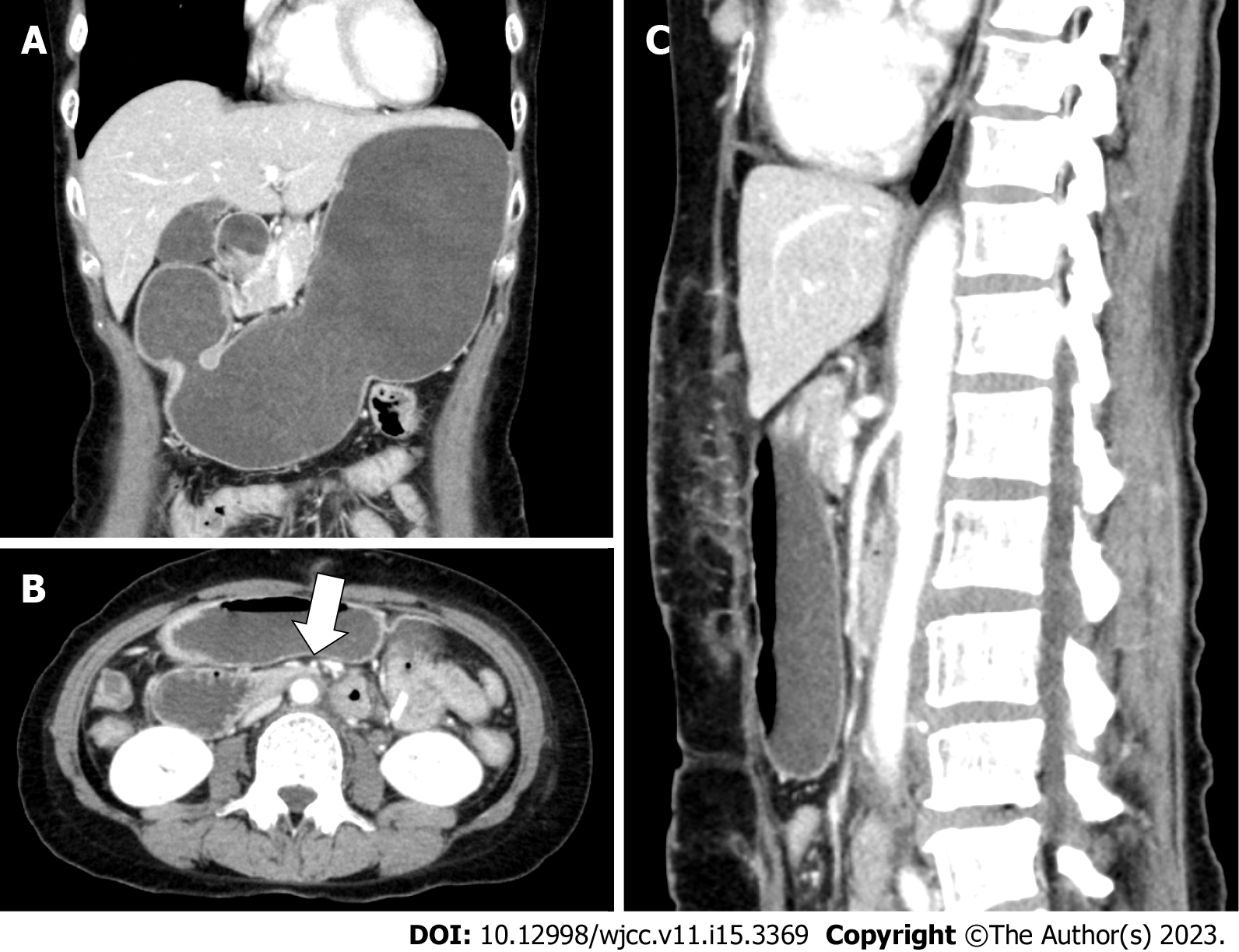 Superior Mesenteric Artery Syndrome Radiology