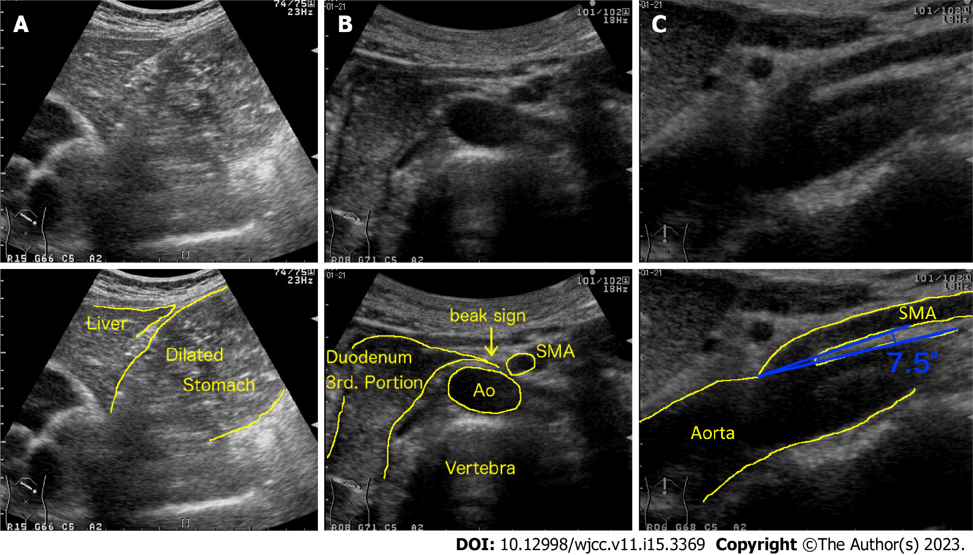 Superior Mesenteric Vein Ultrasound