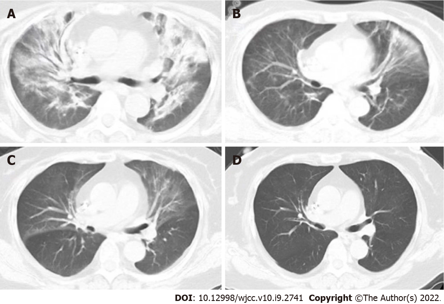 Treatment Of Pneumocystis Jirovecii Pneumonia In Non-human 