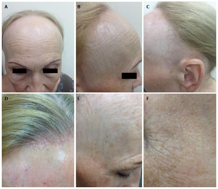 Frontal Fibrosing Alopecia Causes Symptoms Diagnosis Treatment