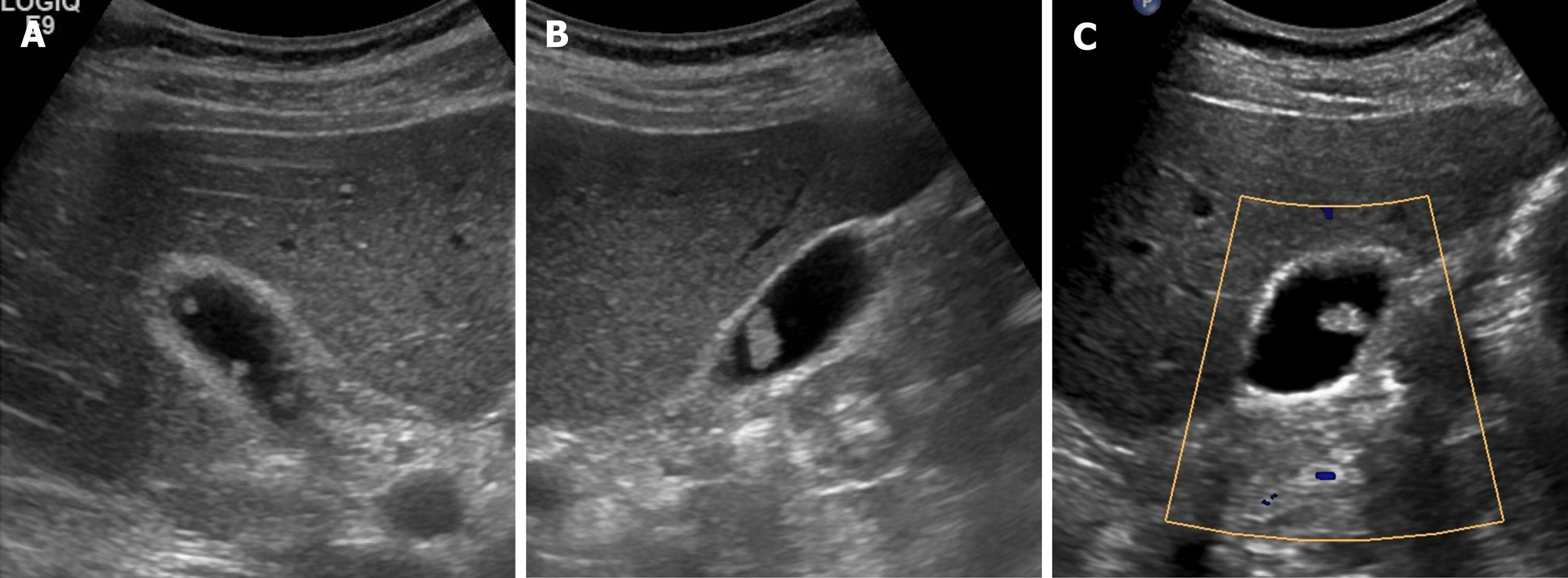 Porcelain Gallbladder Ultrasound