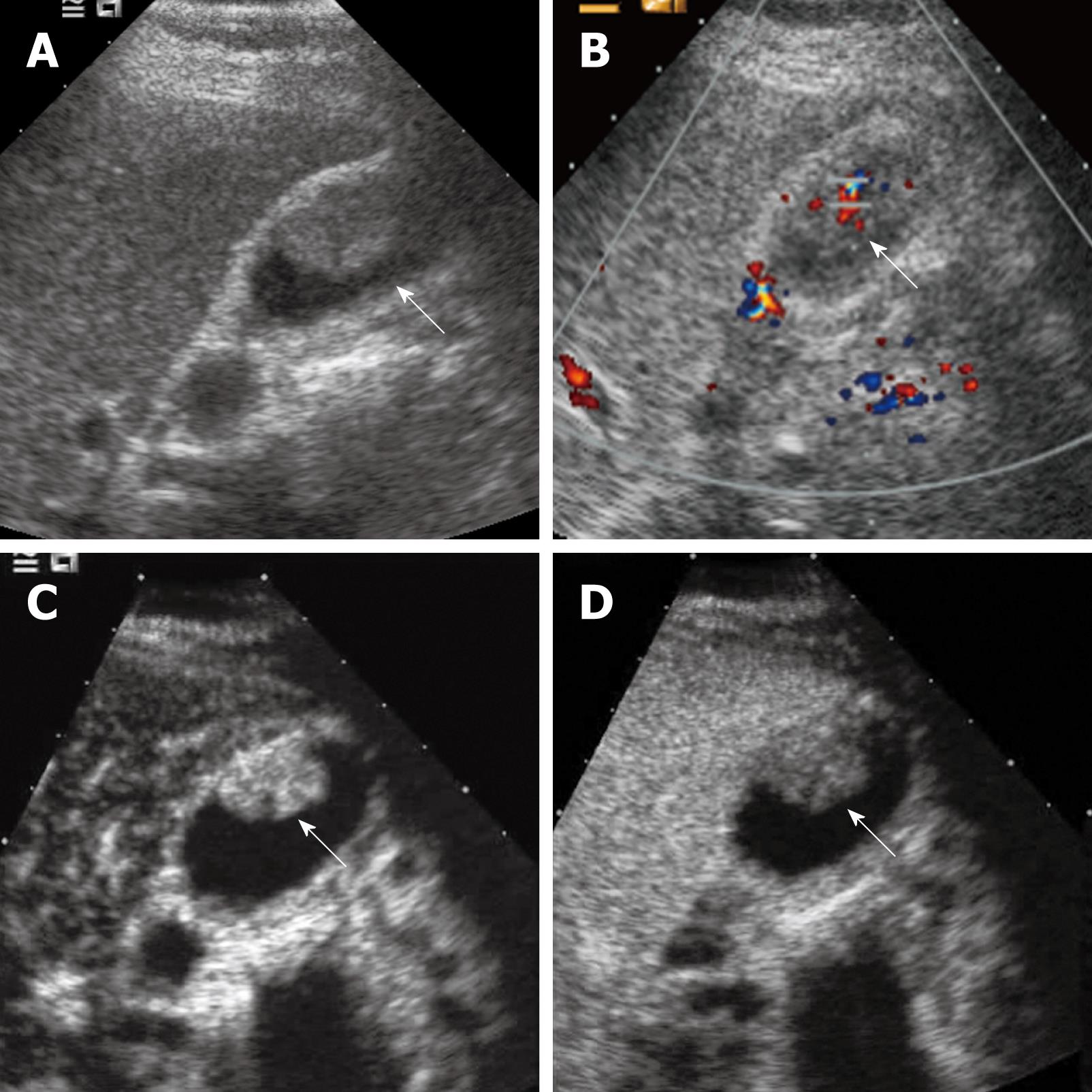 Contrast-enhanced ultrasound in the biliary system: Potential uses and ...