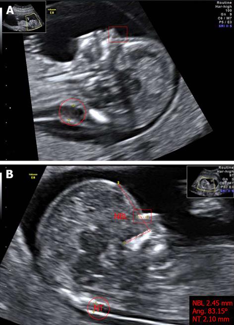 Down Syndrome Ultrasound Nasal Bone