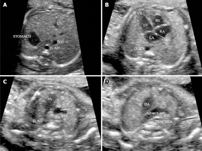 diastrophic dysplasia ultrasound