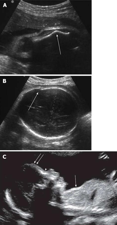 diastrophic dysplasia ultrasound