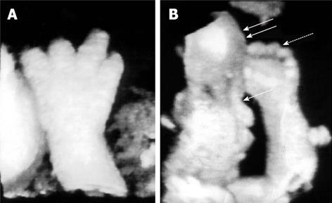 achondroplasia ultrasound