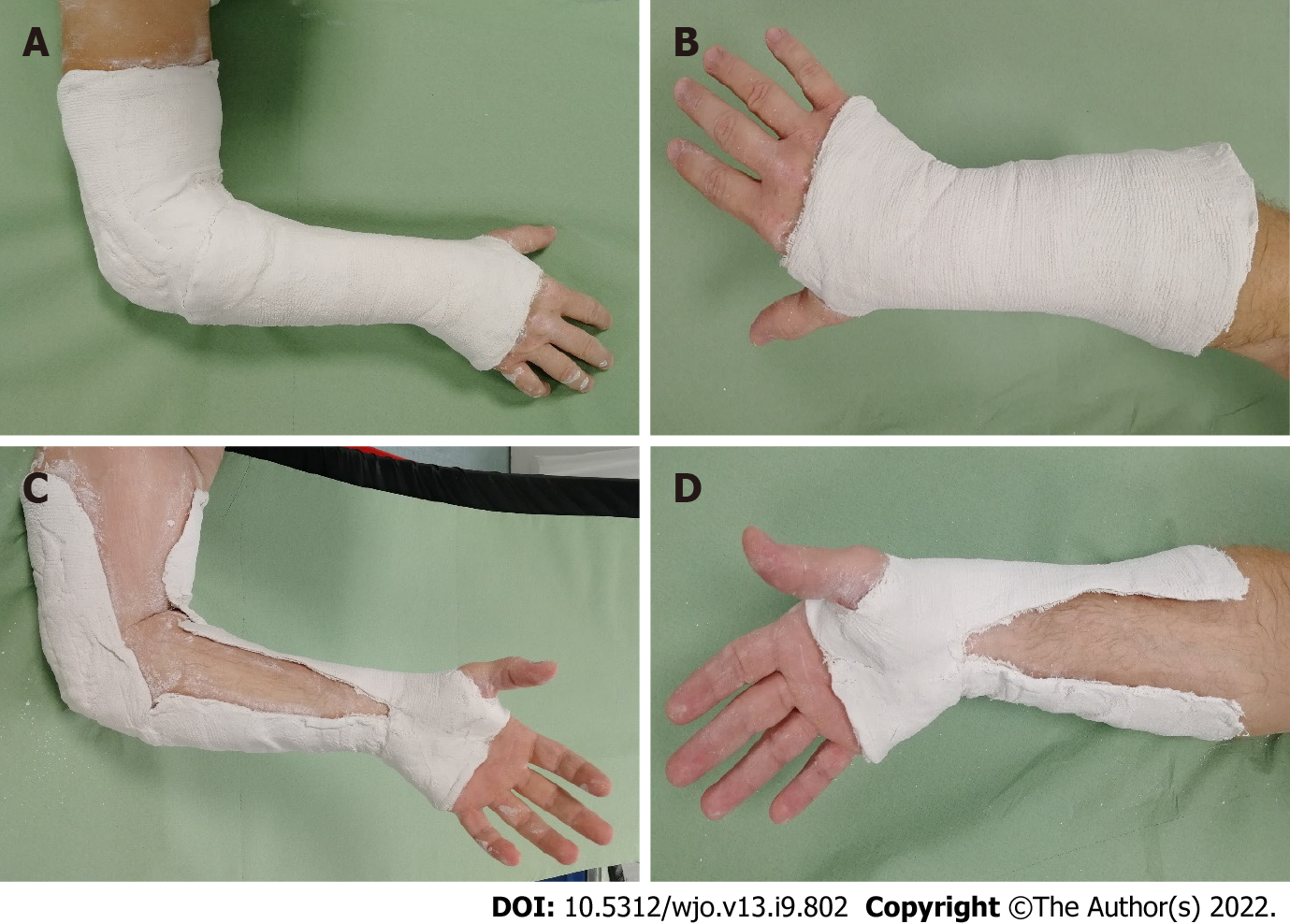 elbow fracture cast
