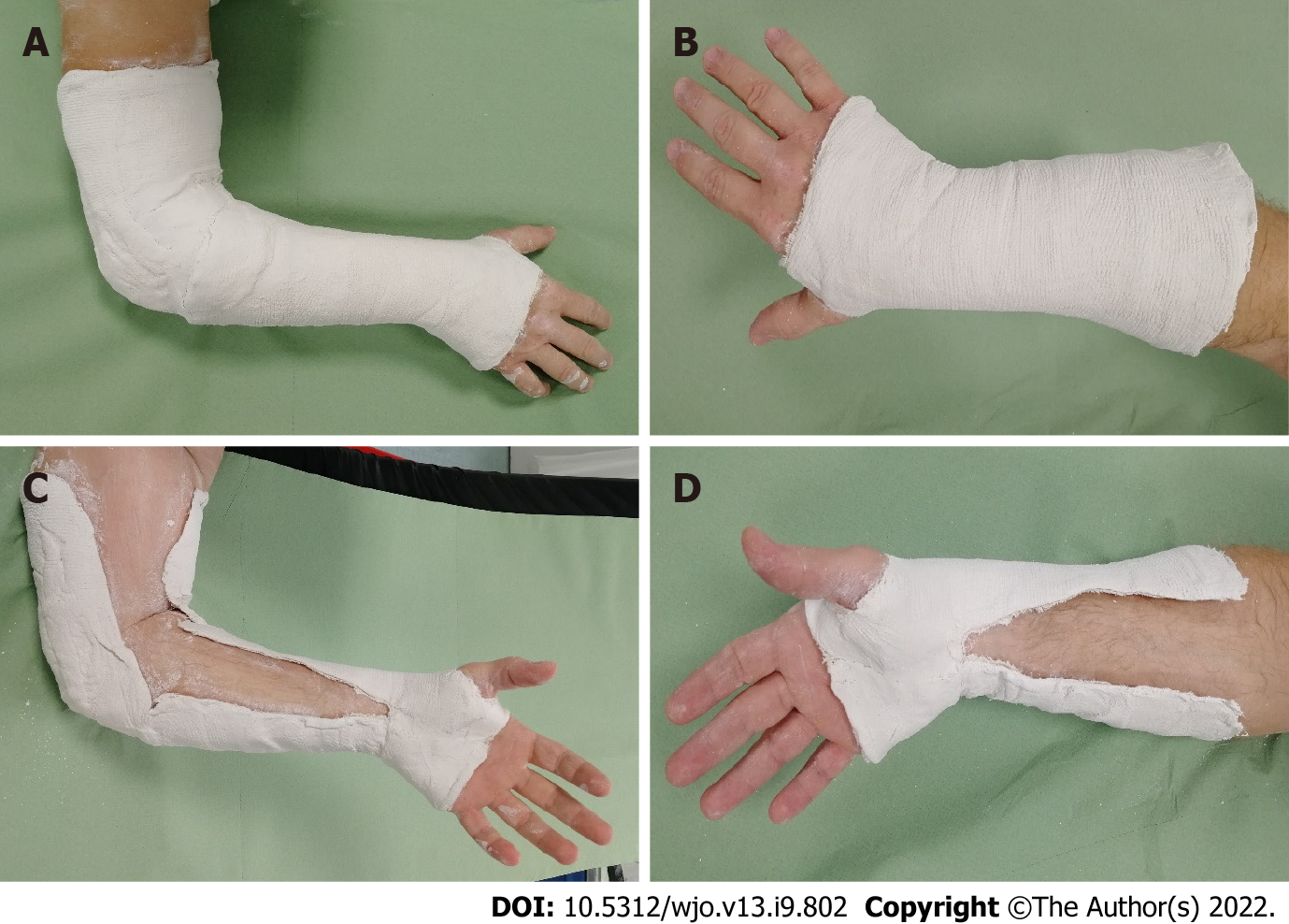 Colles Fracture Splint