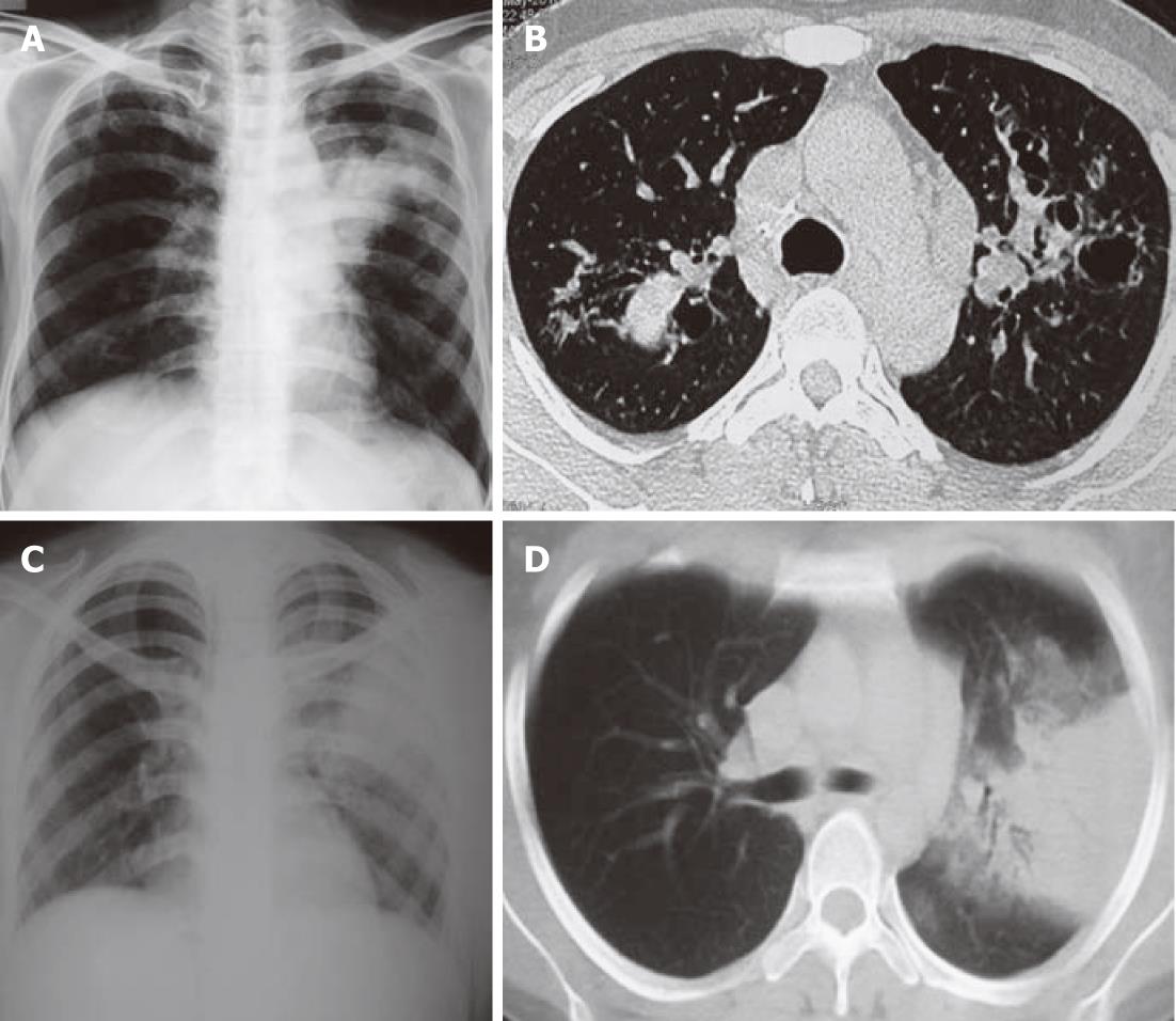 Chest radiographic and computed tomographic manifestations in allergic  bronchopulmonary aspergillosis