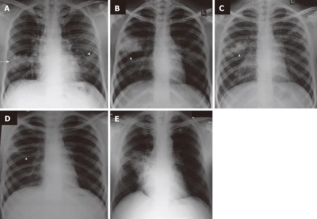 Radiographic Findings and Discussion of Three Pulmonary Cases: Lower Lobe  Collapse Due to Mucus Plug, Radiation Fibrosis, and Right Diaphragmatic  Eventration | PDF | Lung | Pneumonia