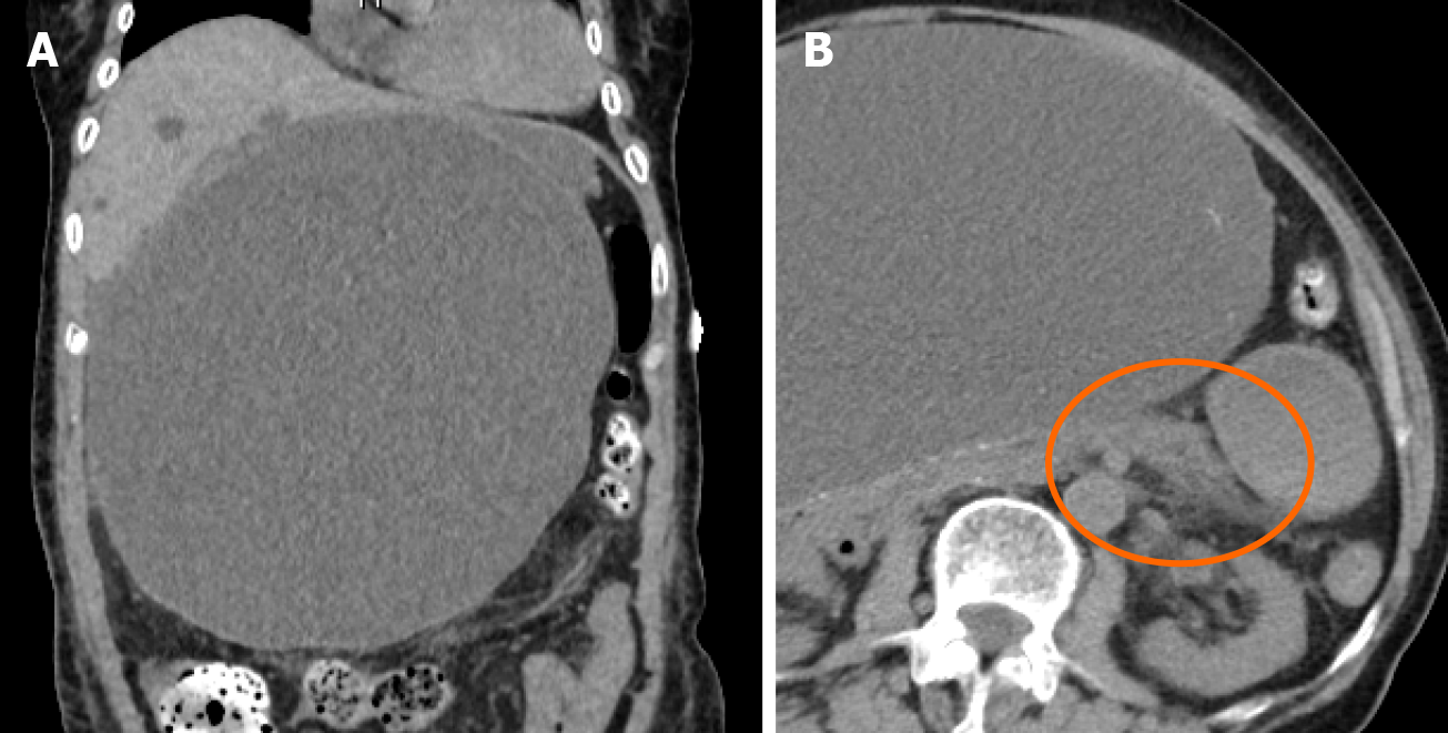 Giant infected hepatic cyst causing exclusion pancreatitis: A case report