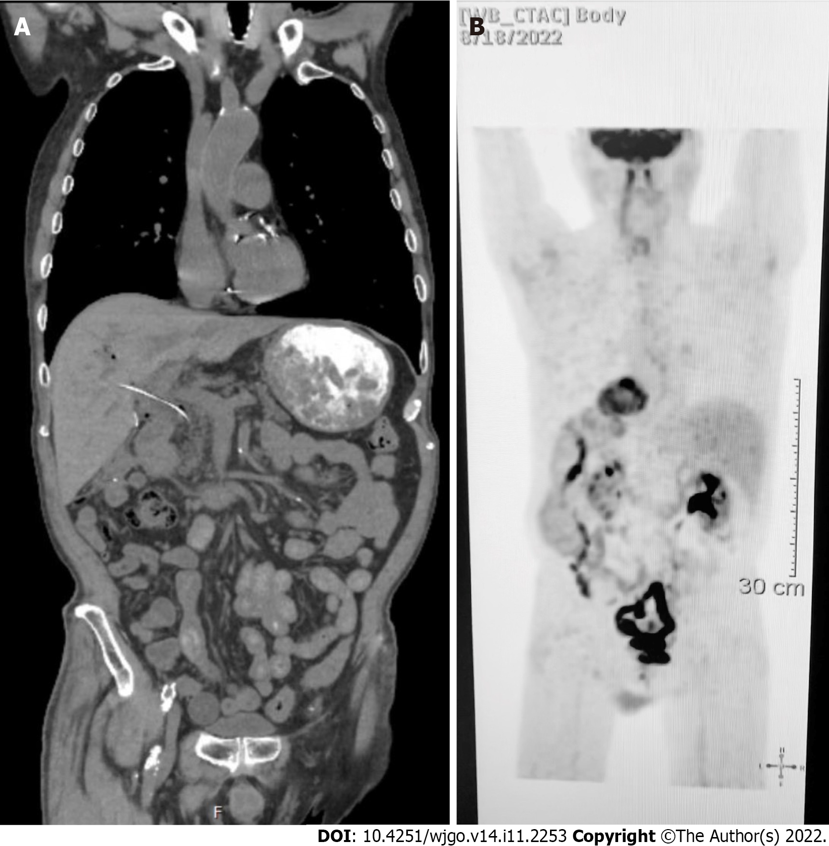 A rare synchrony of adenocarcinoma of the ampulla with an ileal