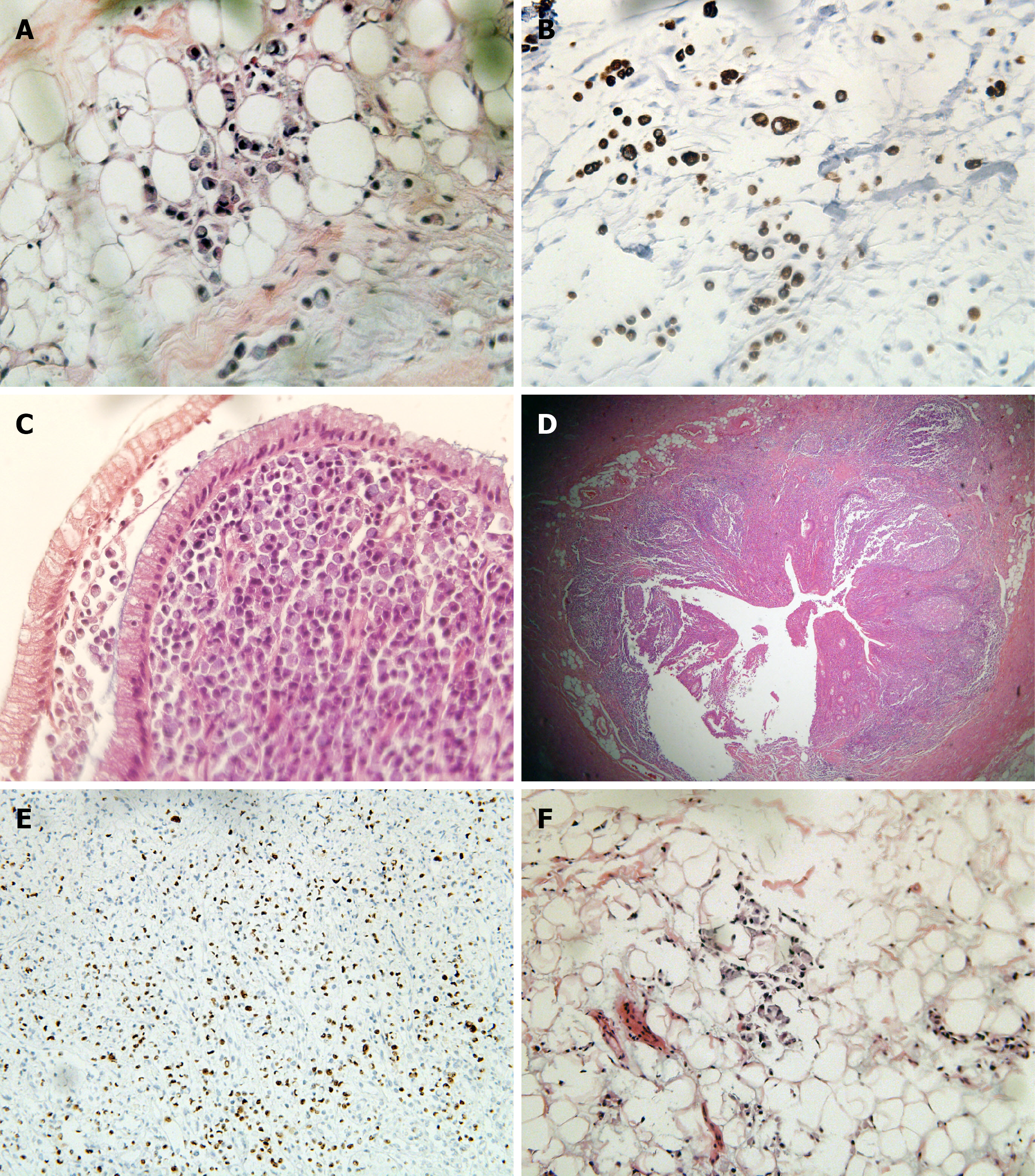 PDF) Signet Ring Carcinoma of the Appendix Presenting as Crohn's Disease in  a Young Male