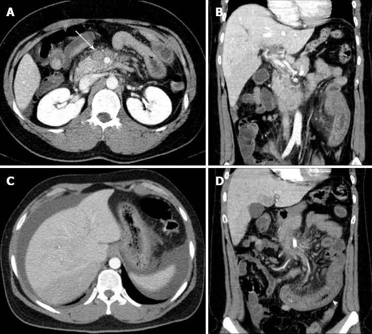 What Is Mesenteric Venous Thrombosis - PELAJARAN