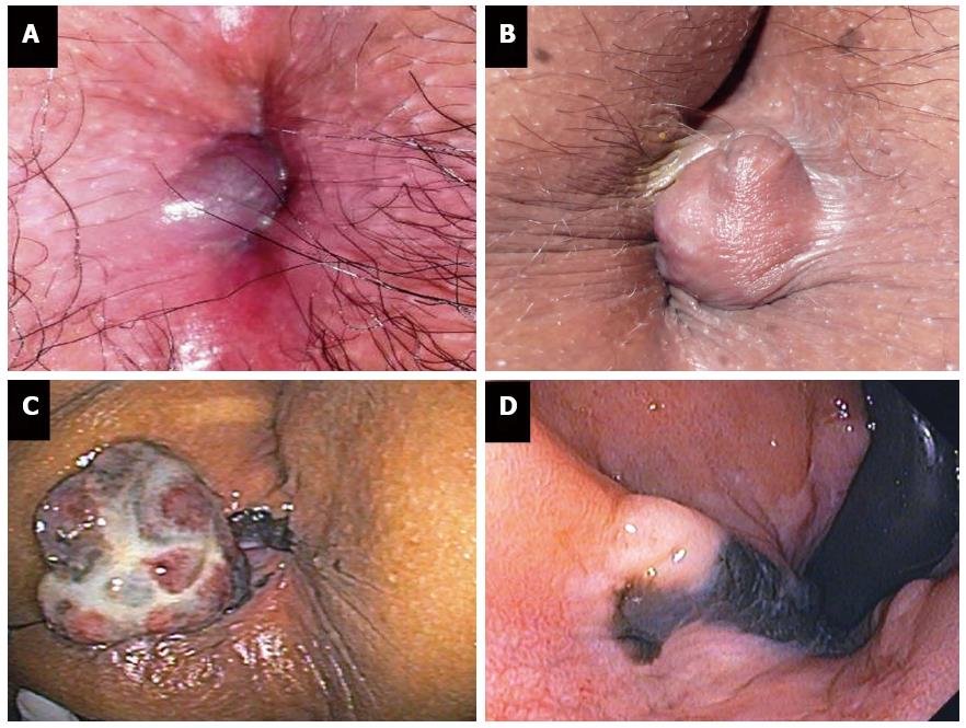 perirectal abscess