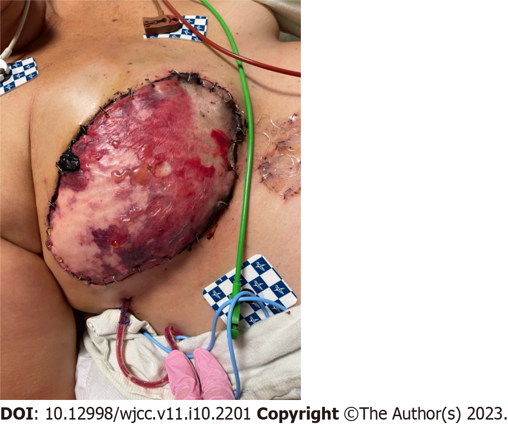 $142 /mo Breast Augmentation / Implants Maryland