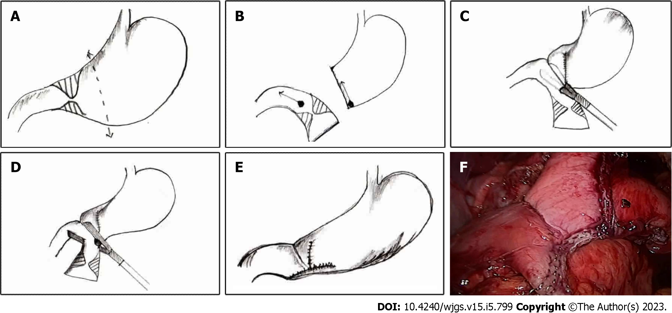 polya gastrectomy