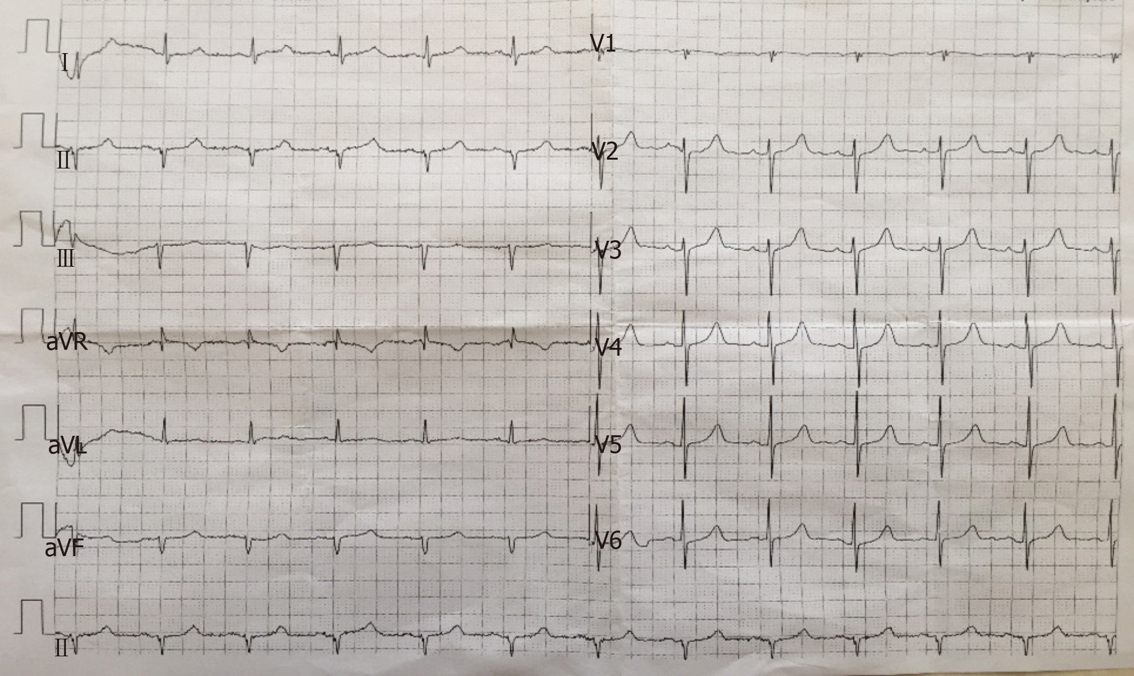 Hypoparathyroidism With Fahr’s Syndrome A Case Report And Review Of