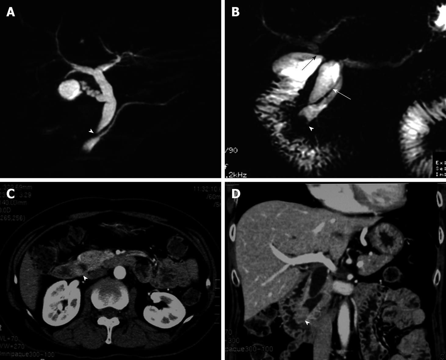 Carcinoma Of The Papilla Of Vater Following Treatment Of Pancreaticobiliary Maljunction