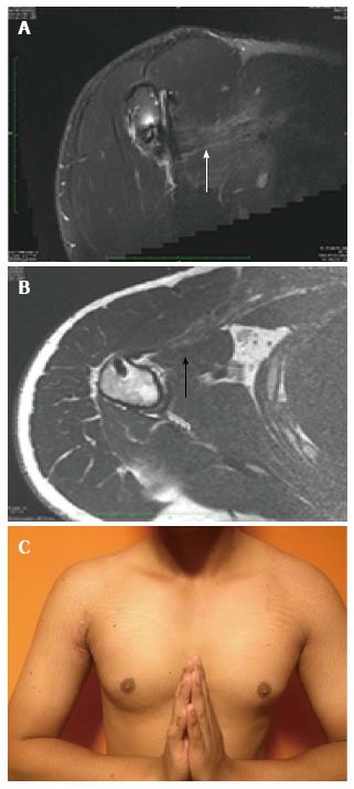 PDF] Pectoralis Major Rupture in an Active Female