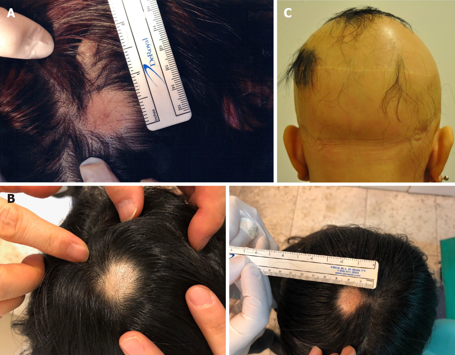 Alopecia treatment using minimally manipulated human umbilical cord-derived  mesenchymal stem cells: Three case reports and review of literature