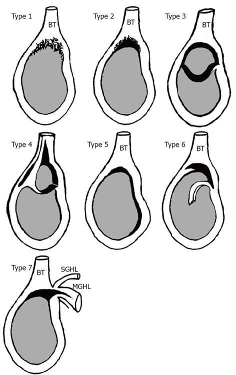 Examples Of A Type 5 Superior Labrum Anterior Posteri - vrogue.co