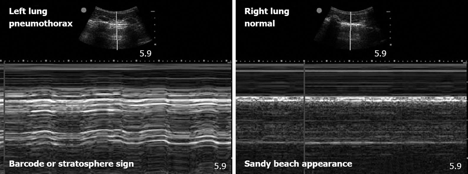 picture of pneumothorax m mode ultrasound