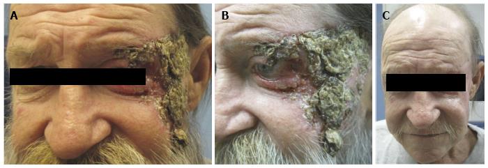 erivedge before and after