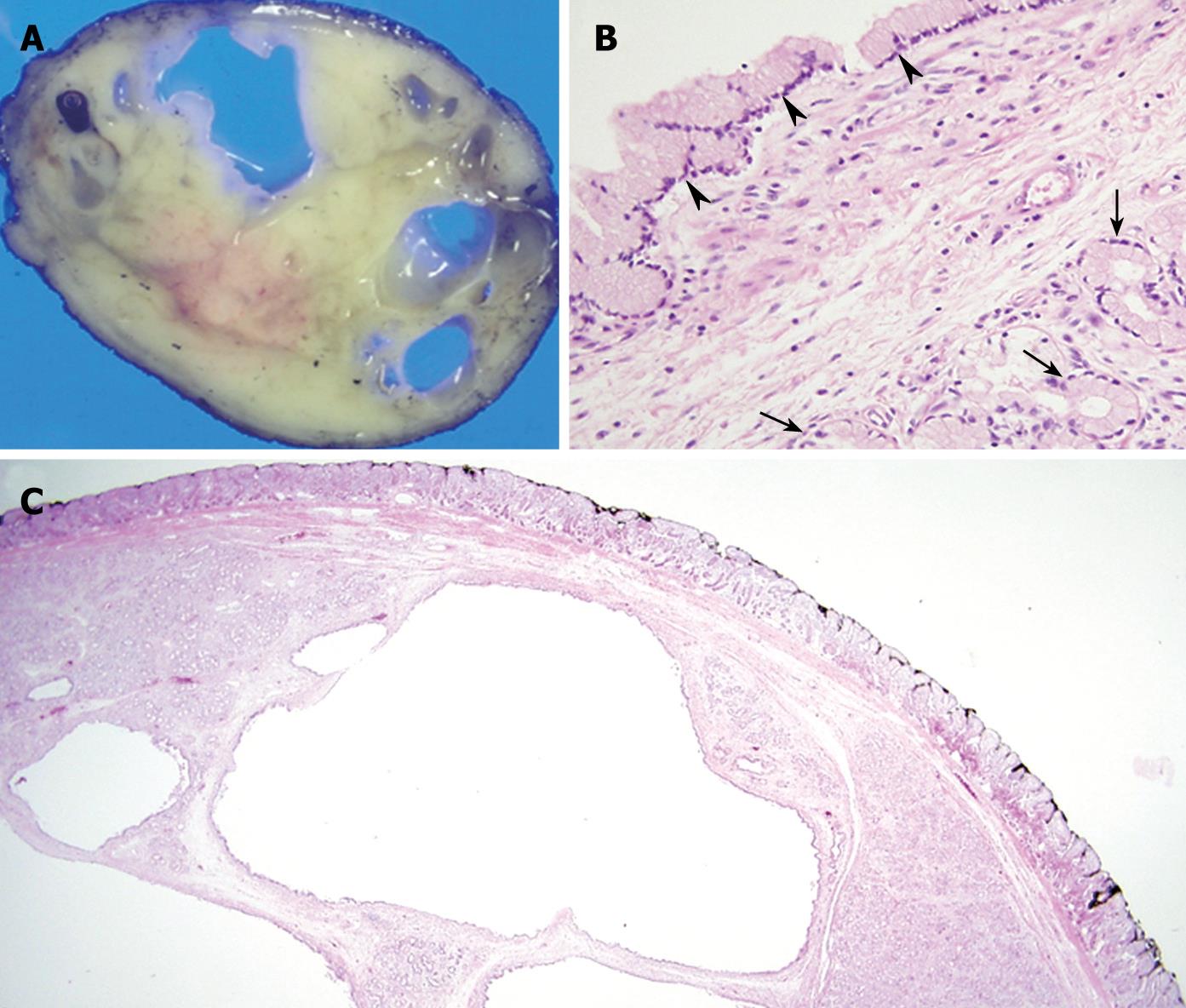 Cystic Brunner’s gland hamartoma in the duodenum A case report