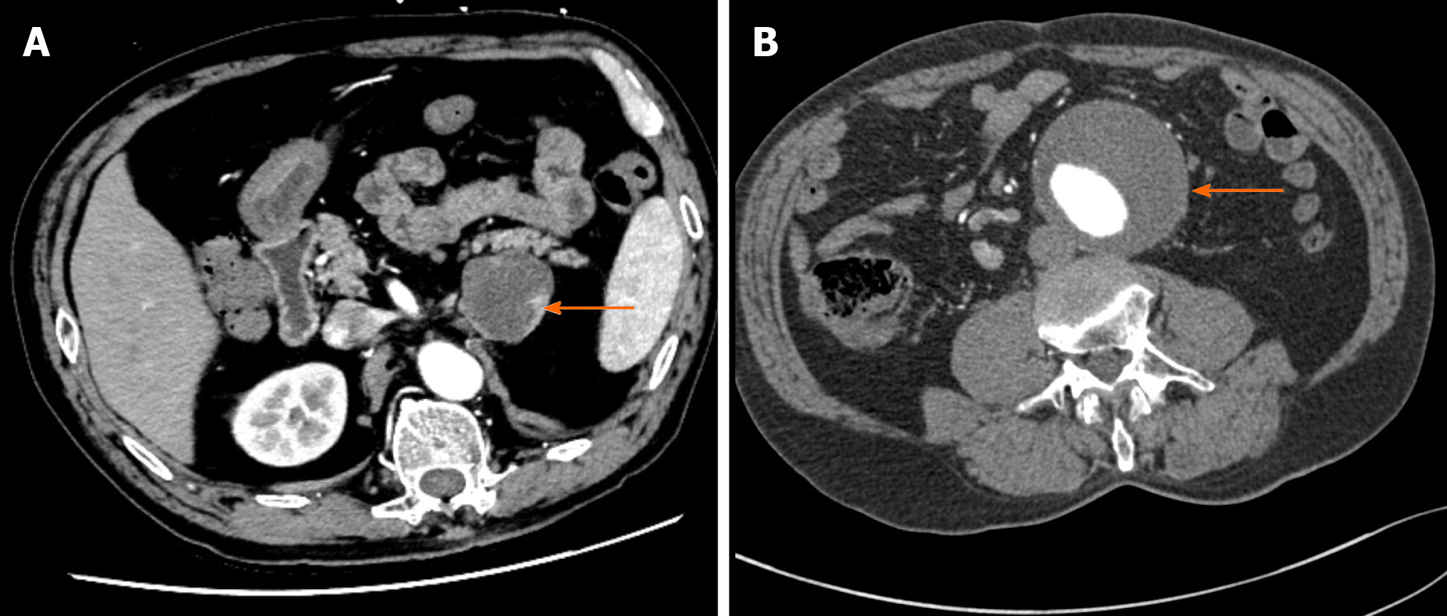 Pheochromocytoma with abdominal aortic aneurysm presenting as recurrent ...