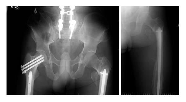 A-D) Radiographs showing a second diaphyseal femur fracture at the end... |  Download Scientific Diagram