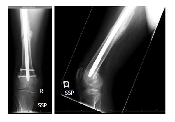 Figure 4 from Closed retrograde retrieval of the distal broken segment of  femoral cannulated intramedullary nail using a ball-tipped guide wire |  Semantic Scholar