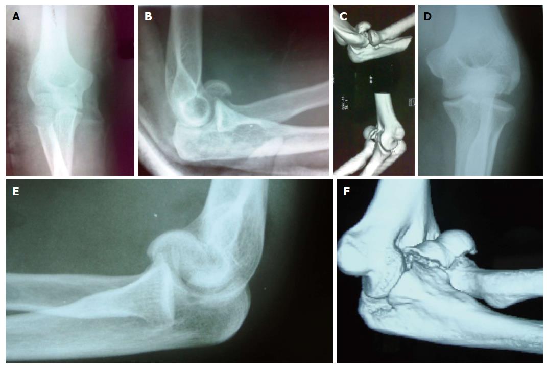 Distal Humerus Fracture  Orthopaedic Trauma Association (OTA)