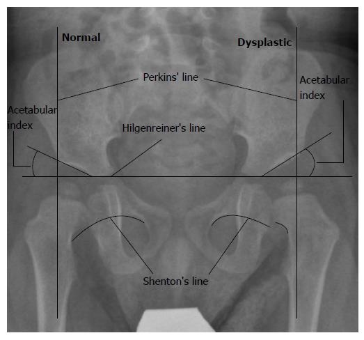 Developmental Dysplasia Of The Hip What Has Changed In The Last 20 Years 