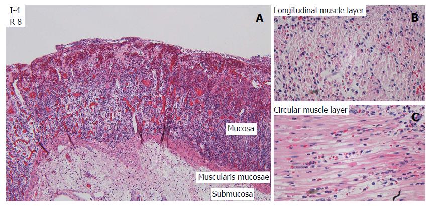 Homogenous, clear-cut, 3-h-old lesion of transmural coagulation
